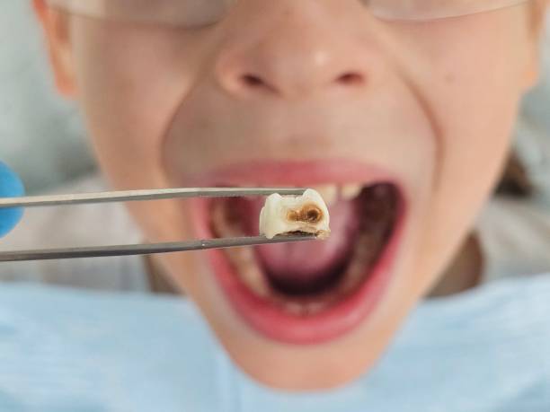 Best Emergency Wisdom Tooth Extraction in Harrison, MI